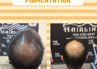 Scalp micro pigmentation in Stoney Creek and the GTA